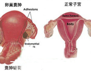 卵巢囊肿有哪些症状