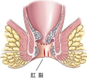 引发肛裂的病因有哪些