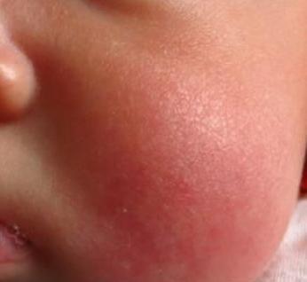 婴儿身上长湿疹怎么办