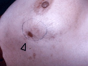 乳腺癌的早期症状图片