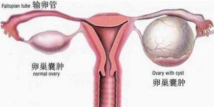 卵巢囊肿是否影响生育