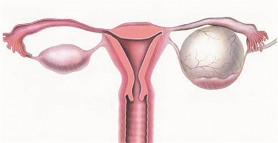 卵巢囊腫和巧克力囊腫的區別