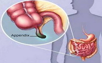慢性阑尾炎疼痛