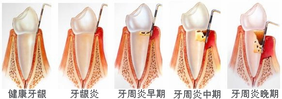 牙齿出血是什么原因