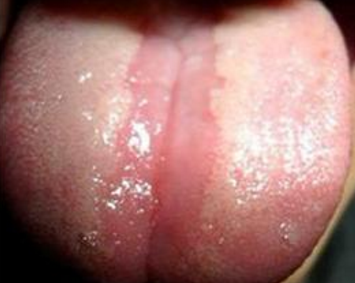 口腔扁平苔藓症状