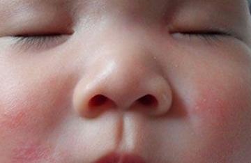新生儿脸部湿疹怎么办