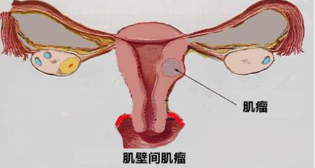 女性子宫肌瘤疼痛怎么办