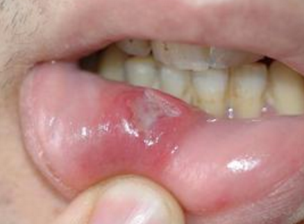 口腔扁平苔藓症状