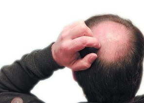 男性频繁换洗头水更易秃顶