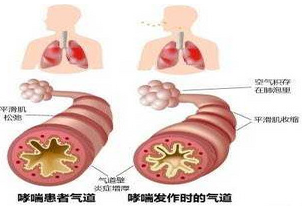 哮喘病人注意事项