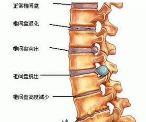 腰椎间盘突出是怎样引起的