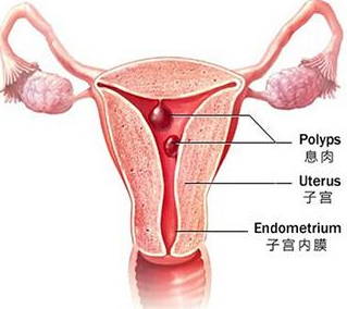 子宫息肉和子宫肌瘤的区别