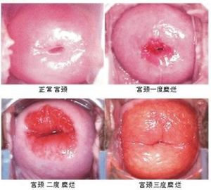 宫颈糜烂手术的危害