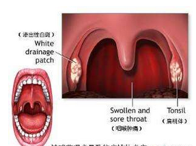 急性咽喉炎的症状有哪些