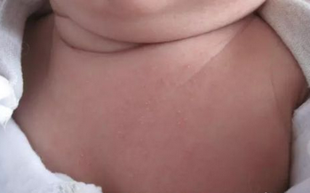 婴儿颈部湿疹怎么办
