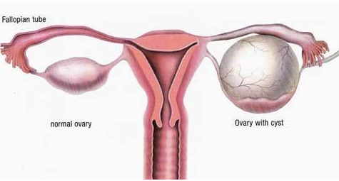卵巢囊肿怎么引起的呢