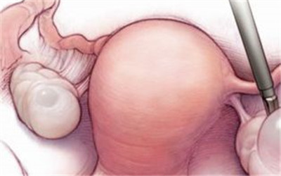 卵巢切除后怎么保养