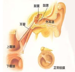 耳膜内陷是怎么回事