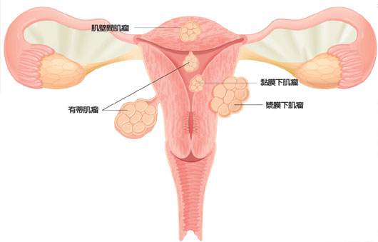 子宫肌瘤的危害有哪些？