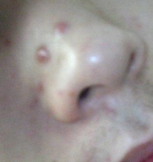 鼻子上长痘痘是什么原因？