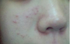 鼻子上长痘痘是什么原因？