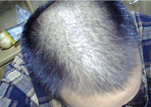  男人掉头发是怎么回事 疾病或雄性激素过旺