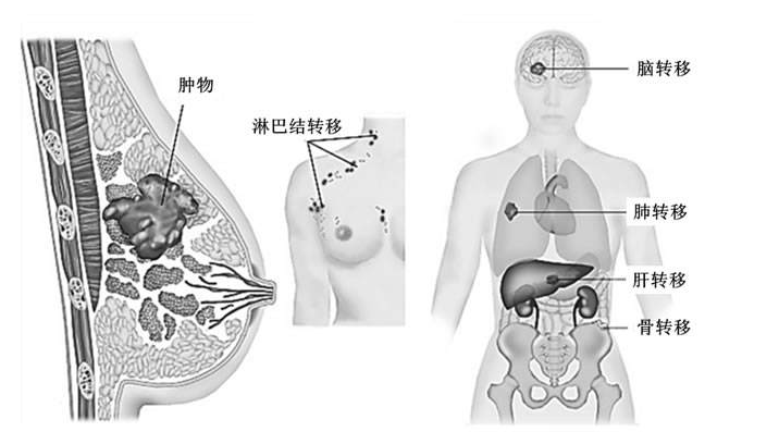 乳腺的静脉血管有何临床意义？